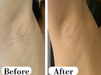 ビースキン 広島(BE:SKIN)/全身脱毛/フェイシャル/VIO