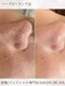サロンドジョリーの写真/黒ずみ毛穴・たるみ毛穴・開き毛穴にアプローチ◎始めた人から綺麗になれる！