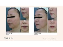 コロニラ(coronille)/マリオネットライン、ほうれい線