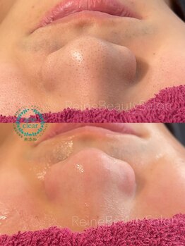 レーヌ(Reine)/毛穴エクストラクション