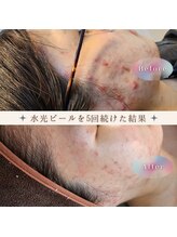 水光ピールスキン/5月から月1回ペースでこんな綺麗