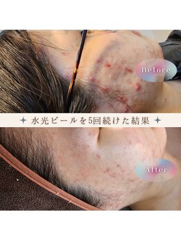 水光ピールスキン/5月から月1回ペースでこんな綺麗