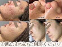 リモア(REMORE.)/お肌のお悩みご相談ください♪