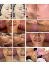 ユフラ(Juhla)/サーマルフラクショナル