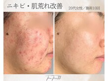 スリースリー 恵比寿(THREE THREE)/ニキビ・肌荒れケア