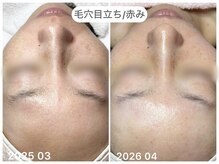 フラックス(flux)の雰囲気（納得出来る効果実感で“毛穴レス大人艶肌”へ♪）
