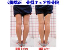 骨盤キュア整骨院/Ｏ脚矯正