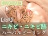 【本格ニキビケア◇DT約3～5日翌日からメイクOK】韓国発ハーバルピーリング