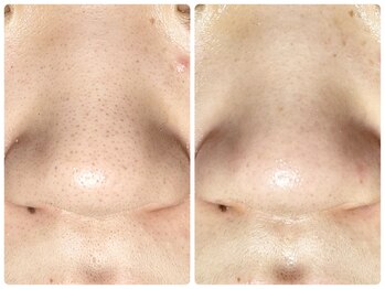 ラウン 京都(ROUN')/ EIEN1回の施術ビフォーアフター