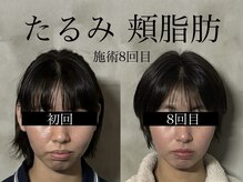 オアシストウキョウ 表参道(OASIS TOKYO)/たるみ/頬脂肪のお悩み