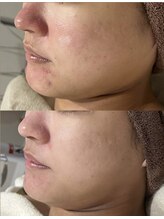 アリス(ALICE)/敏感肌も改善！