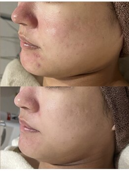 アリス(ALICE)/敏感肌も改善!