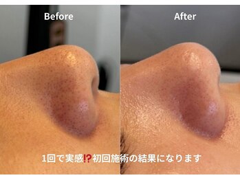 チョクチョクサロン(CHOKCHOK. Salon)/毛穴洗浄