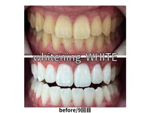 ホワイトニングサロン WHITEの雰囲気（５回でこのホワイトニング効果！お得に通えるクーポンあり♪）