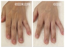 キレイテ 上野店/40代/6回目【ハンドケア上野】