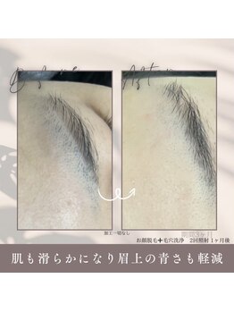 モアトゥインクル 福山宮通り店(MORE twinkle)の写真/2回もついてこの価格♪【両ひじ下or二の腕脱毛2回¥3300】毛穴・産毛にもしっかりアプローチ◎