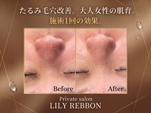 リリーリボン(LILY REBBON)の雰囲気（たるみ毛穴改善☆施術1回の効果！）