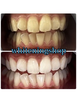 ホワイトニングショップ 南堀江店/セルフホワイトニング[なんば]