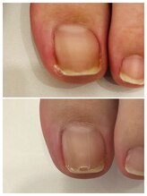 ハッチネイル(HACCI nail)/お客様BEFORE/AFTER