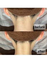 セイリキ(SEIRIKI)/うなじ脱毛