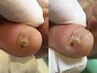 【副爪１箇所（小指の爪横にあるモノ）】+【足の爪切りセット】￥5500