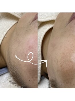 ブラン ネージュ(Blanc Neige)/フェイシャルワックス