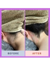 アヴァンス(AVANCE)/うなじ脱毛