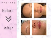 リライフ(ReLIFE)/韓国肌管理/毛穴洗浄+ララピール