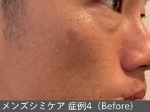 オアシスラグーン(OASIS LAGOON)/メンズシミケア（症例4 before）