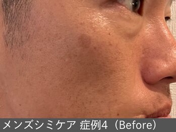 オアシスラグーン(OASIS LAGOON)/メンズシミケア(症例4 before)