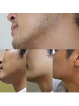 ベベクロスディディア 野々市市役所前店(Bebe×DiDiA)/メンズヒゲ脱毛