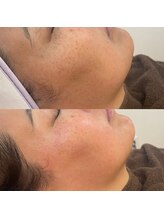 ミニョンプラス(Mignon+)/フェイシャルワックス