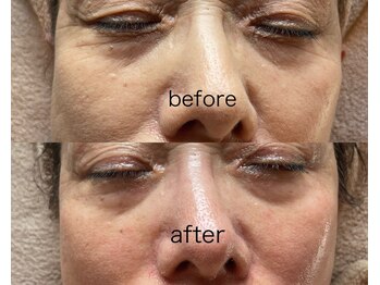 ソエルテ(SOELTE)/ハーブピーリング＋ゆるみ補正