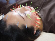 アキュティ 吉祥寺(Acuty)の雰囲気（エイジングケア美容鍼(100本以上)）