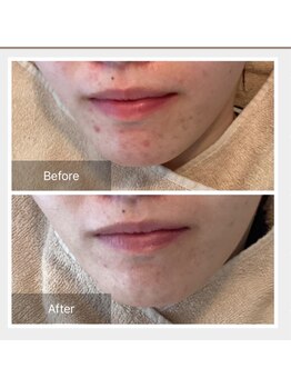 モカ 天王寺店(MOKA)/顎ニキビ　ハーブピーリング