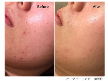 エミルカ 宮崎店(EMILUCA)/【クーポン有】フェイシャル症例