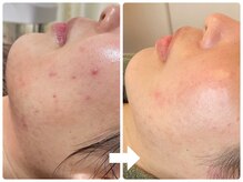 リミー 東大宮店(REME)/【ハーブ】ニキビケア