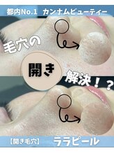 カンナムビューティー 新宿 代々木 最新肌管理 ララピール