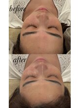 マホロバ(mahoroba)/美容鍼＋ララピール＋よもぎ蒸し