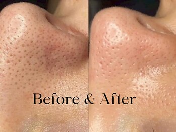 トウキョウビューティーラボ(TOKYO BEAUTY LABO.)/ハイドラBefore&After