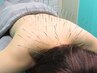 【女性鍼灸師担当】ルート鍼30分＋首肩ほぐし5分付