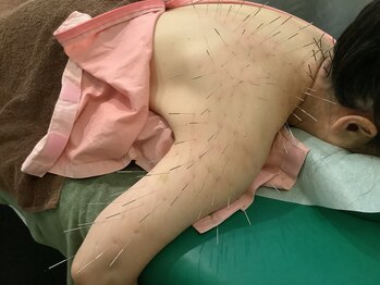 上野毛駅前整骨院 鍼灸院/肩関節への鍼