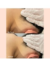 レヴィア 高岡店(REVIA)/脱毛★Before/After