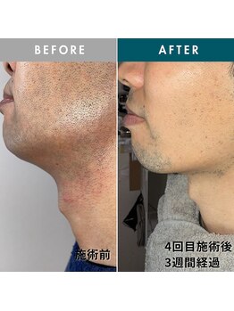 モモナ(Momona)/佐世保/脱毛/髭脱毛/全身脱毛