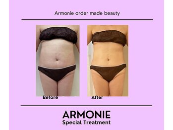アルモニー(armonie)/痩せたい部分から脂肪にアタック