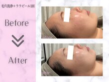 リライフ(ReLIFE)/韓国肌管理/毛穴洗浄+ララピール