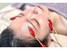 電気を流す美容鍼のサブスクをご契約の方　0円