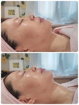 トータルクリア(TOTAL CLEAR)/レモンボトル・RED SHOT