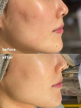 ラエッセ 恵比寿(LAESSE)/【赤み・くすみ改善】