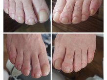 アンティ(Aunty)/見えない、届きにくい足爪切り